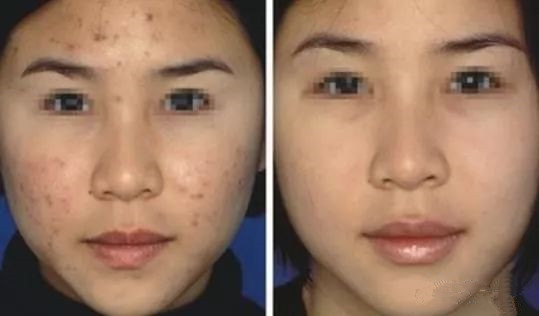 疤痕疙瘩最新疗法，重塑肌肤的希望之光