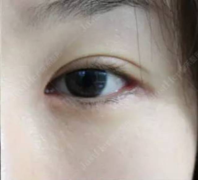 最新双眼皮技术揭秘，实现美丽梦想的秘诀